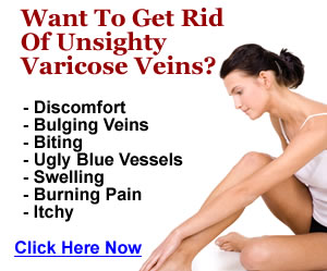 Varicose Veins Natural Treatment